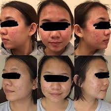 Read jane's story about one simple trick to end severe acne overnight guaranteed Acne First Month Of Biotin It Broke Me Out Three Months Later My Skin Is Finally Clearing Up Skincareaddiction
