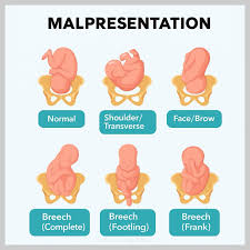 Image result for Shoulder Presentation