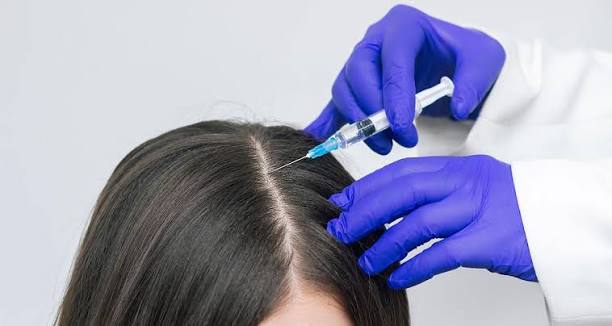 Exosome hair treatment results and follow-up at Profrea