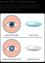 Gruner Star Grauer Star Amd Symptome Behandlung Wolfs Apotheke Bredstedt