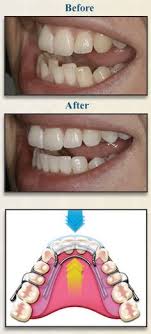 An ice pack or an unopened bag of frozen peas or corn applied to the area will keep swelling to a minimum. 27 Orthodontics Dentistry Orlando Fl Ideas Orthodontics Dentistry Invisalign