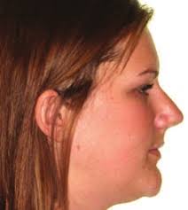 Clinical Experience with the Use of Pulsatile Forces to Accelerate Treatment