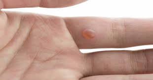It is key to see a urologist right away, especially if these signs last for more than 2 weeks. Early Signs Of Lung Cancer You Need To Be Careful About