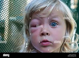 Bee sting face hi-res stock photography and images