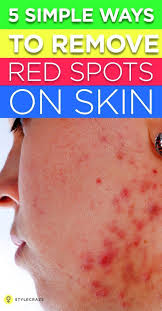 Taking an over the counter antihistamine can provide help in most cases. Pin On Beauty