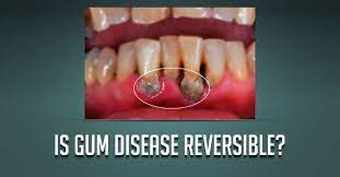 Is Gum Disease Reversible Gingivitis Being A Reversible Condition Will Restore Quickly Once Dental Plaque Is Remove Gum Disease Periodontitis Dental Plaque