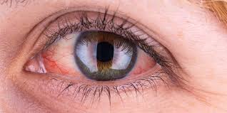 Llegan Nuevas Gotas Blanqueadoras Para Los Ojos A Los Estantes De Las Droguerias American Academy Of Ophthalmology