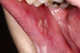 Image result for lichen planus on tongue)
