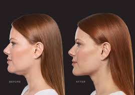Belkyra Dr Robert Turner Winnipeg Mb Deoxycholic Acid Double Chin