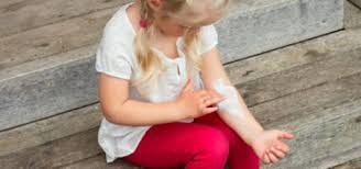 Sometimes eczema consumes so much of us that we forget that 1. Eczema In Babies And Children Healthychildren Org