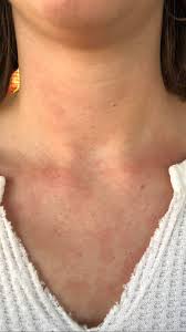 But sometimes, food allergies cause skin redness without hives. Food Intolerance Sometimes After I Eat A Meal I Break Out In A Red Splotchy Rash On My Chest And Face I Have Never Had Anaphylactic Shock To Any Type Of Food