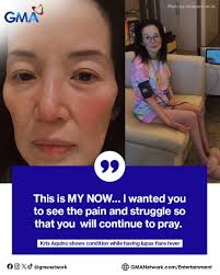This is MY NOW…" Queen of All Media Kris Aquino has revealed another health  challenge while continuing her recovery in the Philippines. In an emotional  Instagram Reel, the TV host-actress shared an