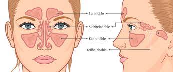Stirnhohlenentzundung Sinusitis A Vogel