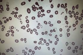 Image result for Anemia angolensis
