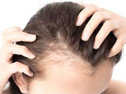 Thinning hair can be caused by a lot of different things: Female Pattern Baldness Causes Treatment And Prevention
