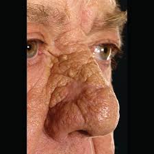 Usually develops in the skin of older adults. Clinical Picture Of The Week Favre Racouchot Syndrome Pulse Today