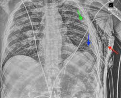 Image result for Chest Trauma