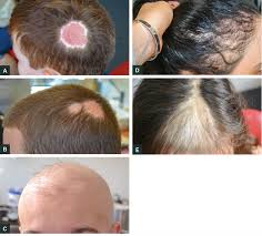 Most often, cradle cap resolves itself. Racgp Common Causes Of Paediatric Alopecia