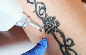 Check spelling or type a new query. How To Remove Your Tattoo Men S Health