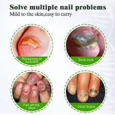 Image result for Paronychia feet