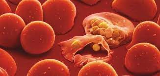 Malaria a fost recunoscută de la civilizațiile grecești și romane cu peste 2.000 de ani în urmă, cu diferite modele de febră plasmodiul este cunoscut cel mai bine pentru infecția pe care o provoacă, malarie. Semnele Malariei Si Transmiterea Acesteia