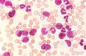 This is kin and leukaemia & blood cancer by wendy alexander on vimeo, the home for high quality videos and the people who love them. How To Tell Apart Leukemias And Lymphomas Pathology Student