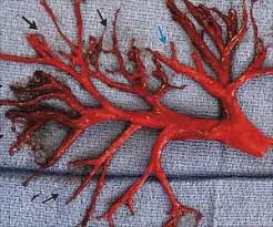 What is blood clots in lungs? Heart Diseased Patient Coughed Up Lung Shaped Blood Clot