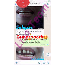 Lebih mudah dipakai untuk mengunyah. Gigi Palsu Temptooth Gigi Jarang Hilang Sebatang Selang Sebatang Ketat Tidak Mudah Jatuh Boleh Mengunyah Makanan