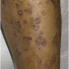 These images are a random sampling from a bing search on the term cutaneous lichen planus. Annular Lichen Planus Photo Courtesy Of Dr Justin Finch University Download Scientific Diagram