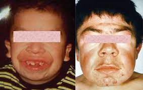Mucopolysaccharidosis Type Vi Medlineplus Genetics