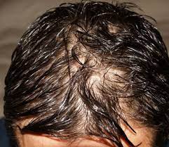It occurs in men, women and children, and all hair lengths. Smelly Hair Syndrome How To Get Rid Home Remedies Shampoos
