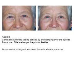 Blepharoplasty (eyelid) and Browlift Procedures » UF Health Plastic Surgery  and Aesthetics Center » UF Academic Health Center » University of Florida