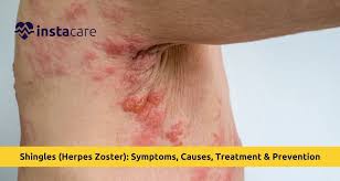 Image result for zoster under breasts