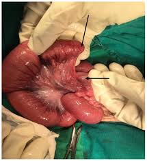 Image result for Intestinal Atresia