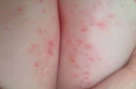 Image result for diaper dermatitis
