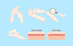 Image result for svrab na k%u016F%u017Ei