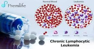 As their number builds, they prevent normal blood cells from carrying. Chronic Lymphocytic Leukemia Causes Symptoms And Treatment Assignment Point