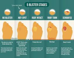 Pinch blisters between toes (image credit) how to prevent. How To Treat Blisters On Feet During And After Hiking And Walking