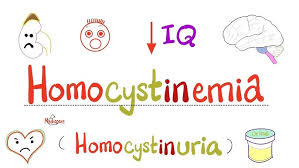 Image result for Homocystinuria