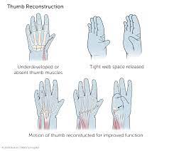 Thumb Hypoplasia and Aplasia | Boston Children's Hospital