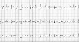 Inilah pembahasan selengkapnya mengenai contoh soal interpretasi ekg dan jawabannya. Contoh Soal Interpretasi Ekg Dan Jawabannya Contoh Soal Terbaru