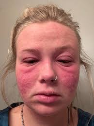 Grape seed extract helps with allergies