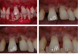Baricitinib has the following structural formula: Propolis Alternative Medicine For The Treatment Of Oral Microbial Diseases Intechopen