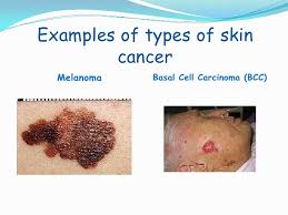 When malignant cancer cells form and grow within a person's breast tissue, breast cancer occurs. C Fakepath Skin Cancer