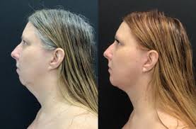 Cirugía Plástica Facial Antes y Después