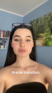 Roise Braces Transformation: #BracesOn Dream Fulfilled ❤️