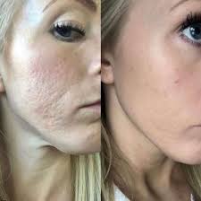 Can You Remove Acne Scars Permanently? - Harley Clinic