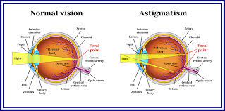 Orthokeratology Guide Side Effects Risks And More Nvision Eye Centers