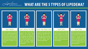 Pin On Lipedema