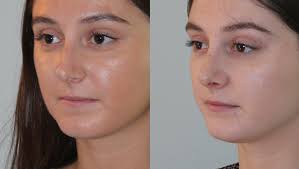 New York City New York Nose Surgery New York Ny Sinus Surgeon Broken Nose Surgery Nose Surgery Facial Plastic